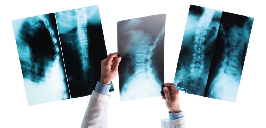 Broken bone symptoms – What to look for in school